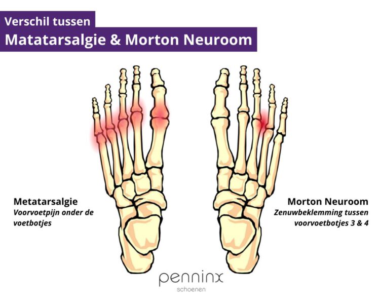 Verschil tussen Matatarsalgie & Morton Neuroom